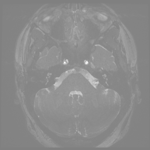 Anterior temporal lobe perivascular space (Radiopaedia 68481-78041 E 7).png