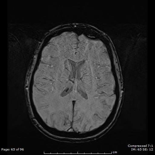 Anterior temporal lobe perivascular space (Radiopaedia 88283-104914 Axial SWI 34).jpg