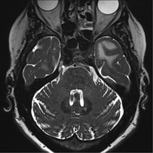 Anterior temporal pole cysts (Radiopaedia 46629-51102 Axial T2 46).png