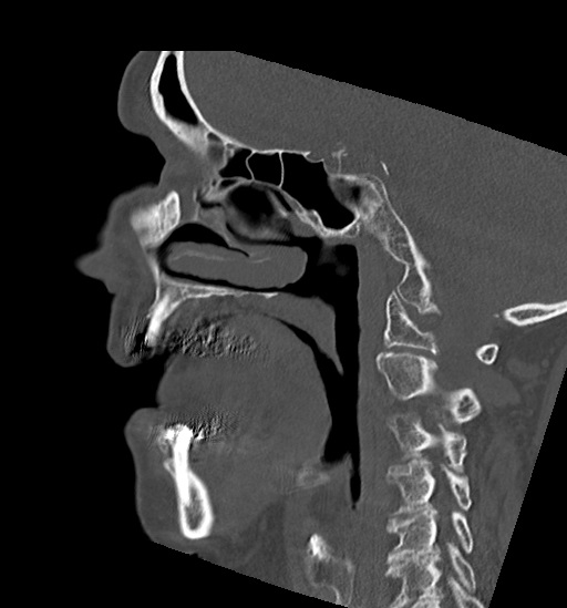 File:Anterior temporomandibular joint dislocation (Radiopaedia 59430-66784 B 37).jpg