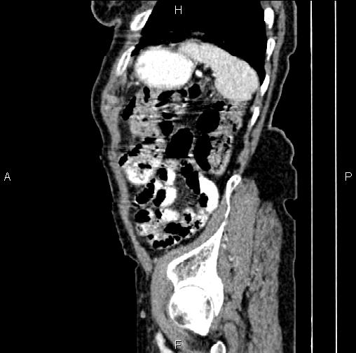 Aortic aneurysm and Lemmel syndrome (Radiopaedia 86499-102554 D 76).jpg