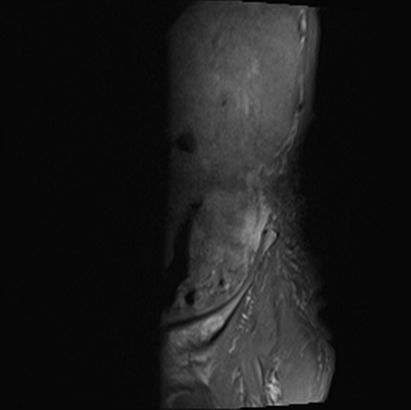 File:Aortic aneurysm with spinal destruction (Radiopaedia 42301-45409 Sagittal T1 fat sat 1).jpg