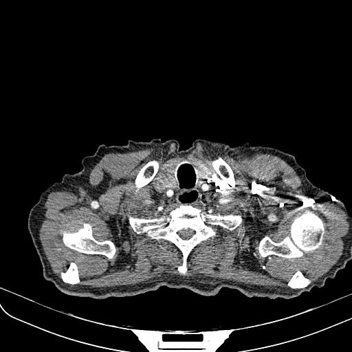 File:Aortic aneurysm with thrombosis (Radiopaedia 42744).JPEG