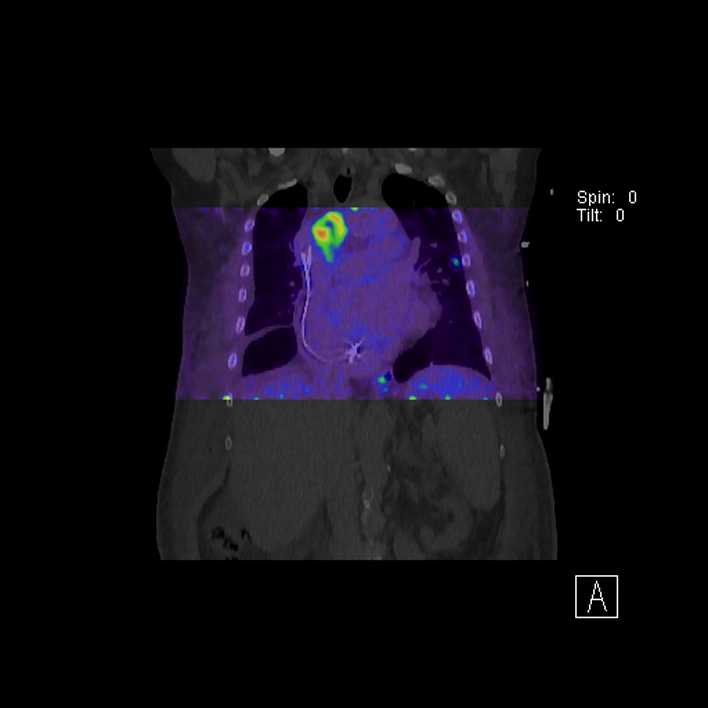 Aortic arch graft infection (FDG PET-CT) (Radiopaedia 71975-82438 D 44).jpg