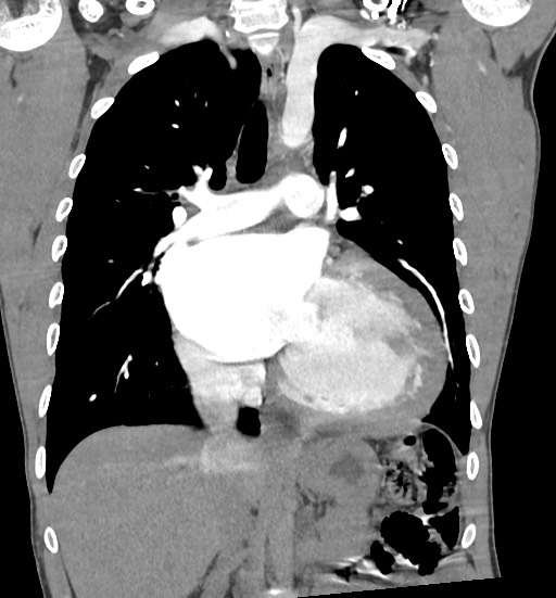 Aortic coarctation with aneurysm (Radiopaedia 74818-85828 C 59).jpg