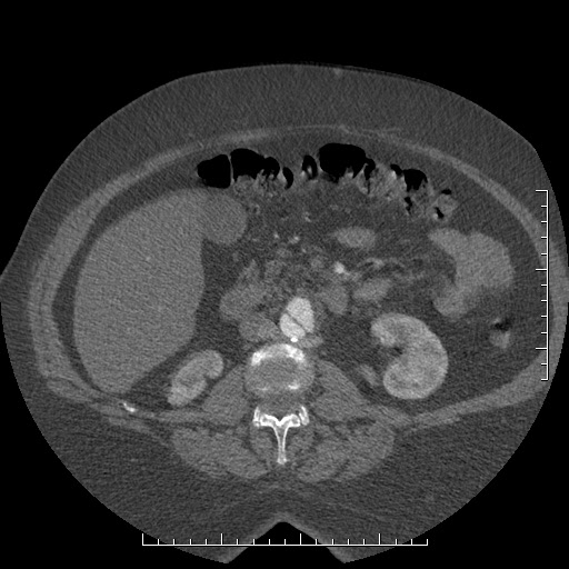 File:Aortic dissection- Stanford A (Radiopaedia 35729-37268 C 4).jpg