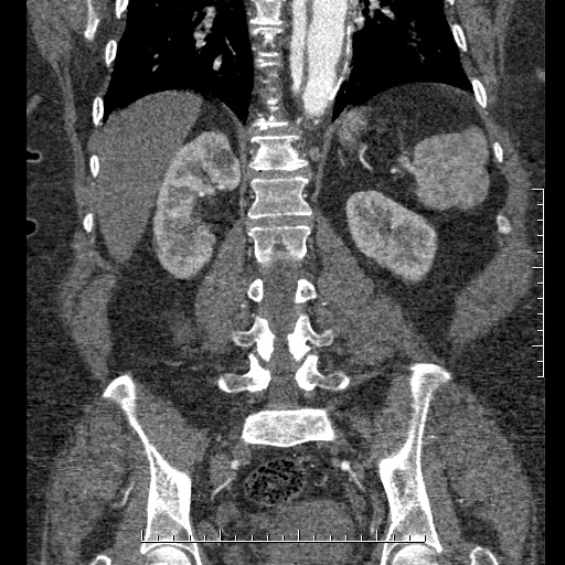 File:Aortic dissection- Stanford A (Radiopaedia 35729-37268 F 11).jpg
