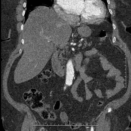 Aortic dissection- Stanford A (Radiopaedia 35729-37268 F 41).jpg