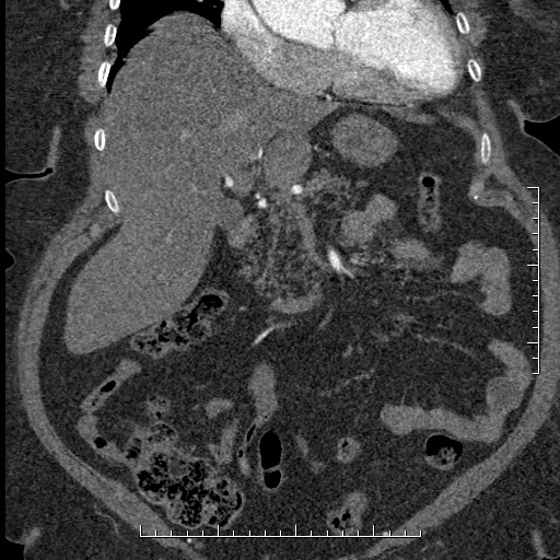 File:Aortic dissection- Stanford A (Radiopaedia 35729-37268 F 50).jpg