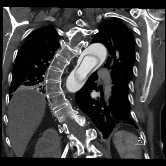 File:Aortic dissection (CTPA) (Radiopaedia 75506-86750 B 54).jpg