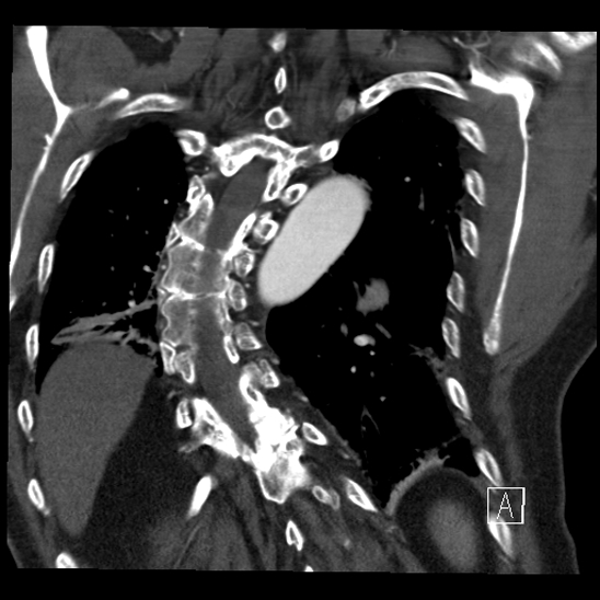 Aortic dissection (CTPA) (Radiopaedia 75506-86750 B 59).jpg
