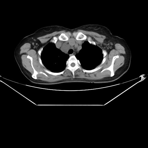 File:Aortic dissection (Radiopaedia 25350-25604 B 12).jpg