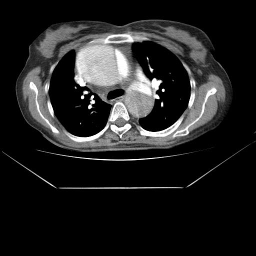 File:Aortic dissection (Radiopaedia 25350-25604 D 1).jpg