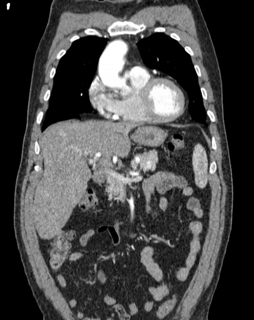 Aortic dissection (Radiopaedia 44411-48061 A 5).jpg