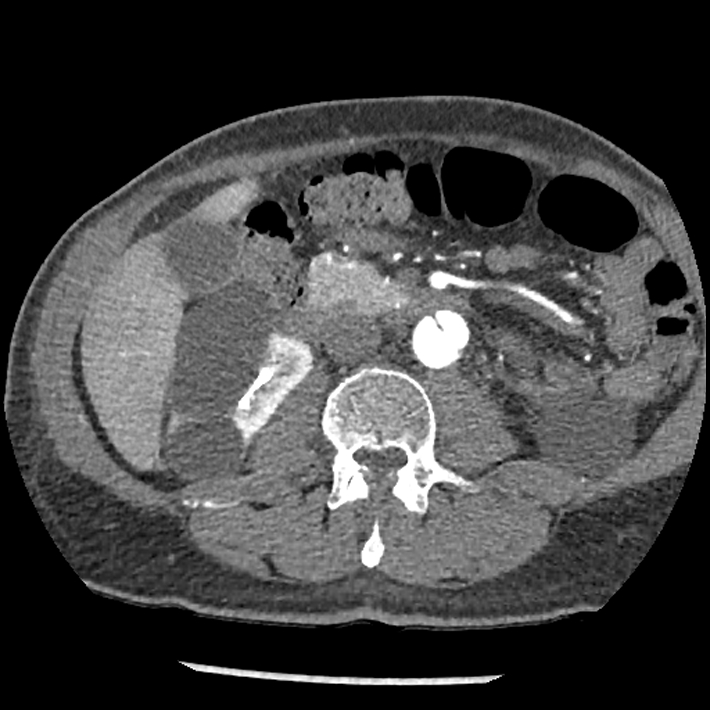 Aortic dissection - DeBakey Type I-Stanford A (Radiopaedia 79863-93115 A 53).jpg