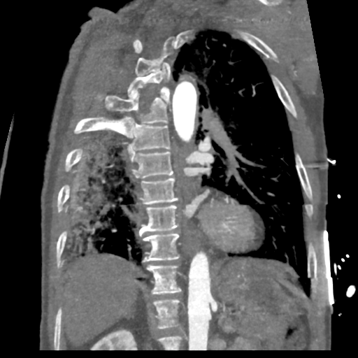 File:Aortic dissection - DeBakey type II (Radiopaedia 64302-73082 D 24).png