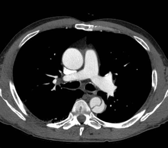 Aortic dissection - Stanford type B (Radiopaedia 73648-84437 A 41).jpg