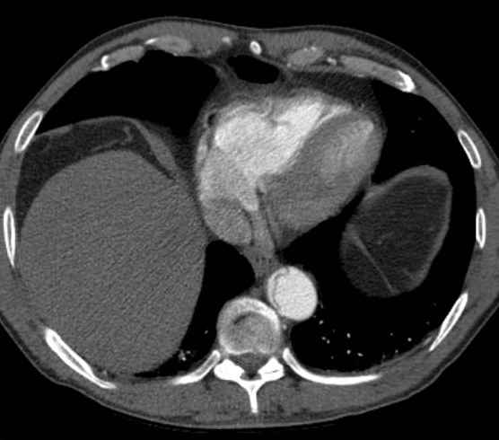 Aortic dissection - Stanford type B (Radiopaedia 73648-84437 A 89).jpg