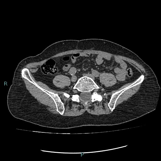 File:Aortic dissection extended to lusory artery (Radiopaedia 43686-47136 Axial non-contrast 44).jpg
