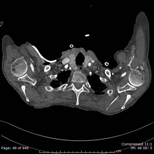 Aortic dissection with extension into aortic arch branches (Radiopaedia 64402-73204 B 48).jpg
