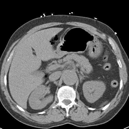 Aortic intramural hematoma (Radiopaedia 31139-31838 Axial non-contrast 55).jpg