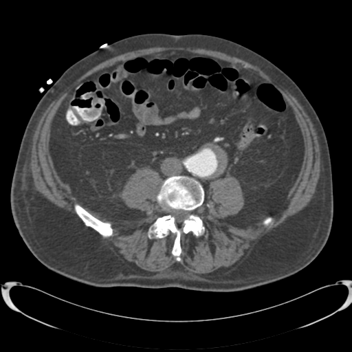 Aortic intramural hematoma (Radiopaedia 34260-35540 B 66).png