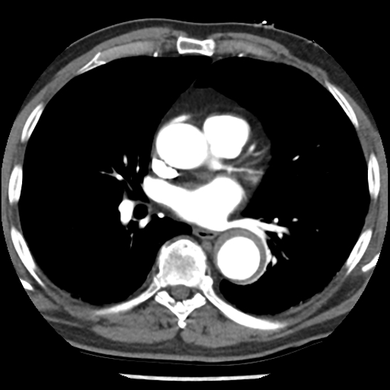 File:Aortic intramural hematoma (type B) (Radiopaedia 79323-92387 B 29).jpg