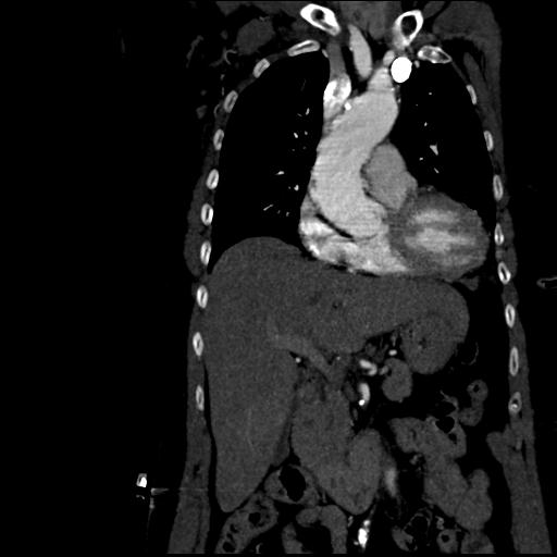 Aortic intramural hematoma from penetrating atherosclerotic ulcer (Radiopaedia 31137-31836 C 23).jpg