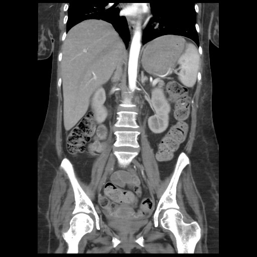 File:Aorto-duodenal fistula (Radiopaedia 25668-25850 B 1).jpg