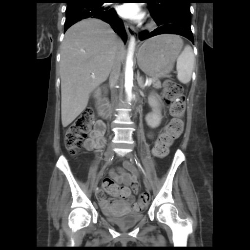 File:Aorto-duodenal fistula (Radiopaedia 25668-25850 B 2).jpg