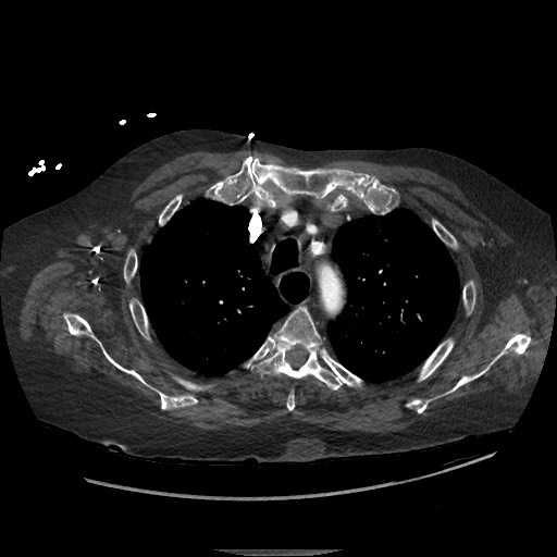 Aortoesophageal fistula with endovascular repair (Radiopaedia 73781-84592 Axial C+ CTPA 25).jpg
