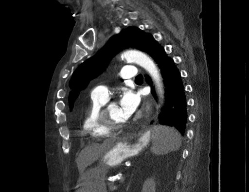 Aortoesophageal fistula with endovascular repair (Radiopaedia 73781-84592 Sagittal C+ CTPA 123).jpg