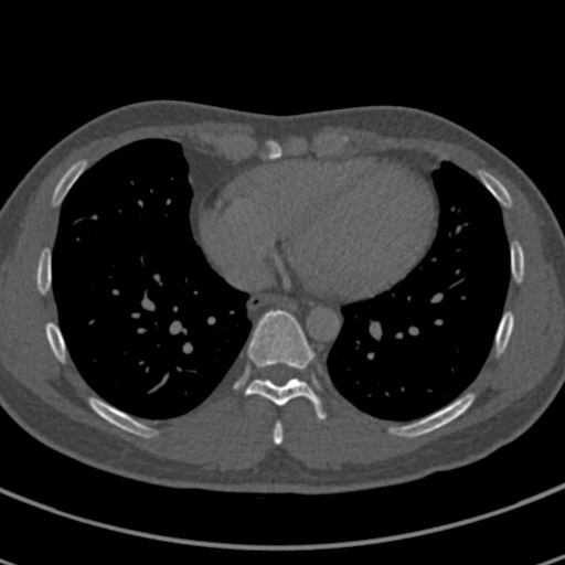 Apical lung mass mimic - neurogenic tumor (Radiopaedia 59918-67521 Axial bone window 55).jpg