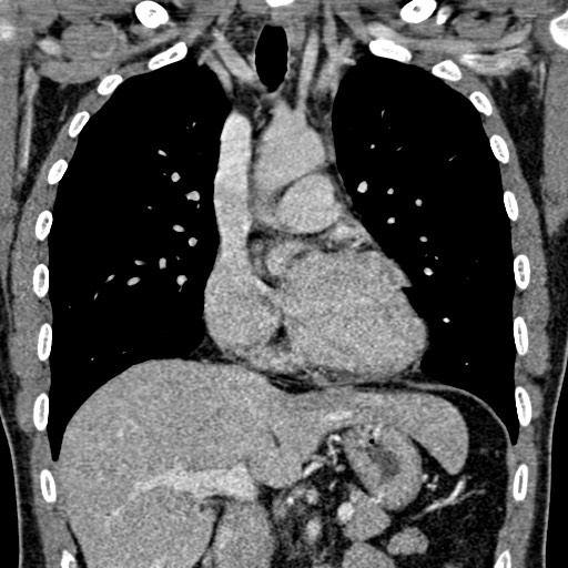 Apical lung mass mimic - neurogenic tumor (Radiopaedia 59918-67521 B 58).jpg