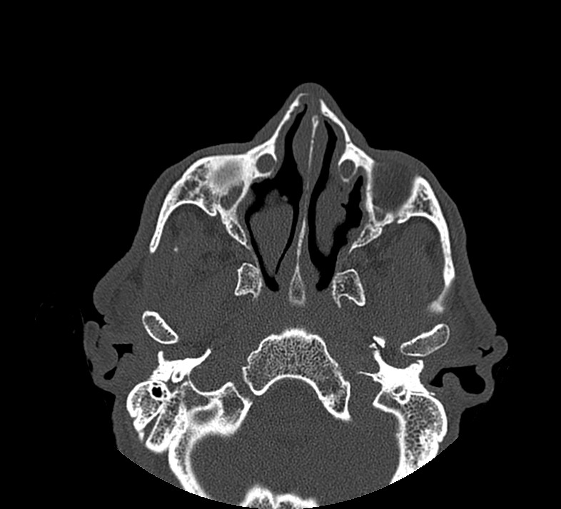 Aplastic maxillary sinuses (Radiopaedia 60030-67561 Axial non-contrast 32).jpg