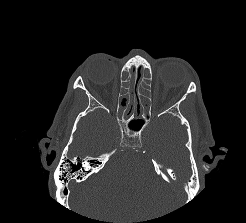Aplastic maxillary sinuses (Radiopaedia 60030-67561 Axial non-contrast 48).jpg