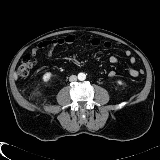 Appendiceal adenocarcinoma complicated by retroperitoneal abscess (Radiopaedia 58007-65039 B 78).jpg