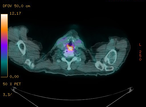 File:Appendiceal adenocarcinoma complicated by retroperitoneal abscess (Radiopaedia 58007-65041 Axial PET-CT 23).jpg