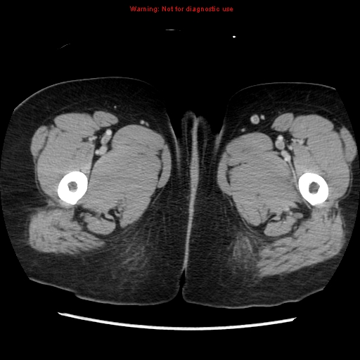 File:Appendiceal mucinous cystadenoma (Radiopaedia 8263-9111 Axial liver window 93).jpg