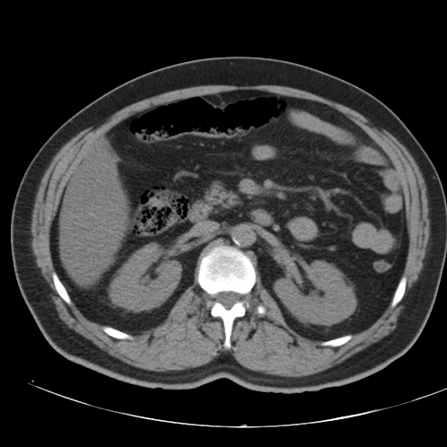 File:Appendicitis and giant appendicolith (Radiopaedia 80251-93588 Axial non-contrast 20).jpg