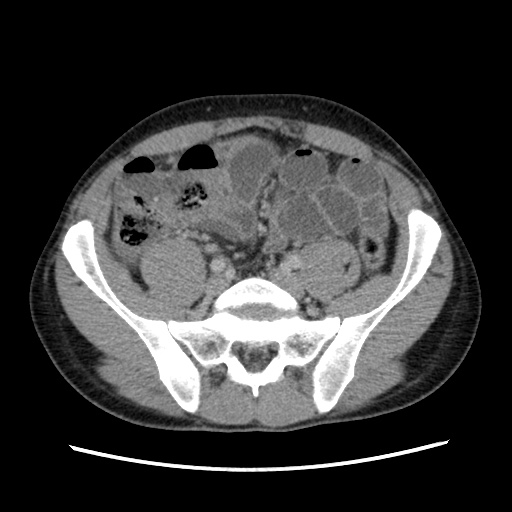 Appendicitis complicated by post-operative collection (Radiopaedia 35595-37114 A 61).jpg