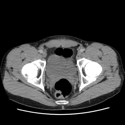 File:Appendicitis complicated by post-operative collection (Radiopaedia 35595-37114 A 81).jpg