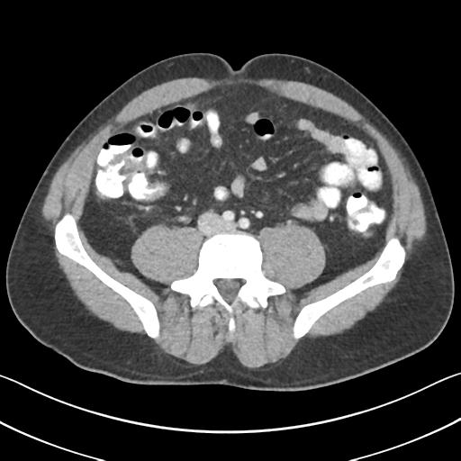 File:Appendicitis with cecal bar sign (Radiopaedia 31878-32830 B 51).jpg