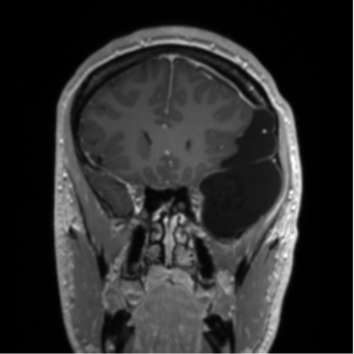 Arachnoid cyst with subdural hematoma (Radiopaedia 85892-101743 Coronal T1 C+ 66).png