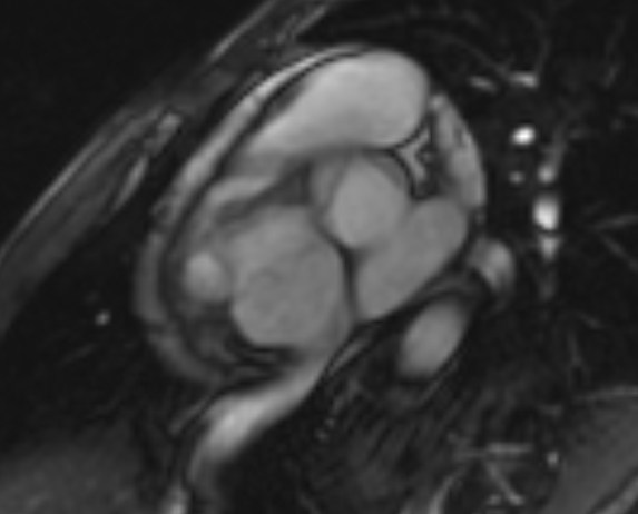 Arrhythmogenic right ventricular cardiomyopathy (Radiopaedia 69564-79464 short axis cine 245).jpg