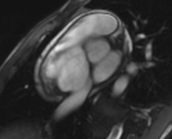 Arrhythmogenic right ventricular cardiomyopathy (Radiopaedia 69564-79464 short axis cine 278).jpg