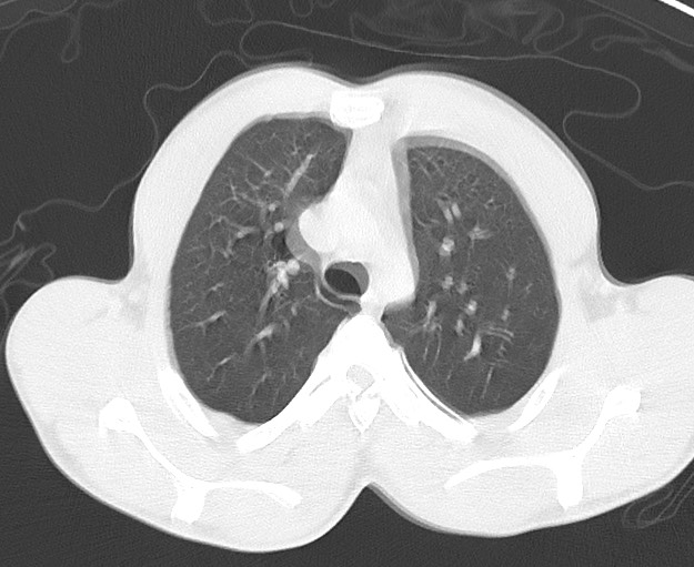 File:Arrow injury to the chest (Radiopaedia 75223-86321 Axial lung window 15).jpg