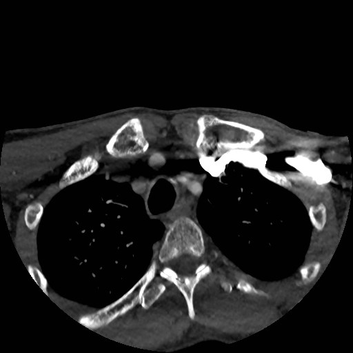 Artery of Percheron infarct (Radiopaedia 48088-52894 A 17).jpg