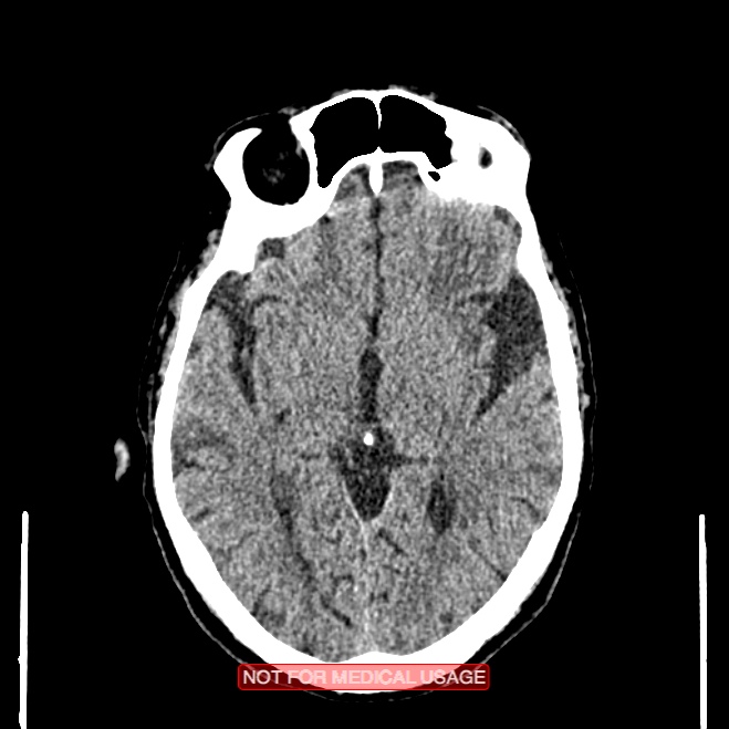 Artery of Percheron infarction (Radiopaedia 28679-28967 Axial non-contrast 57).jpg