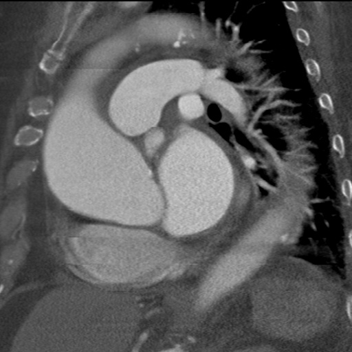 File:Ascending aortic aneurysm (Radiopaedia 20913-20846 A 14).jpg